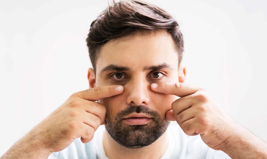 أسباب ظهور الهالات السوداء للرجال