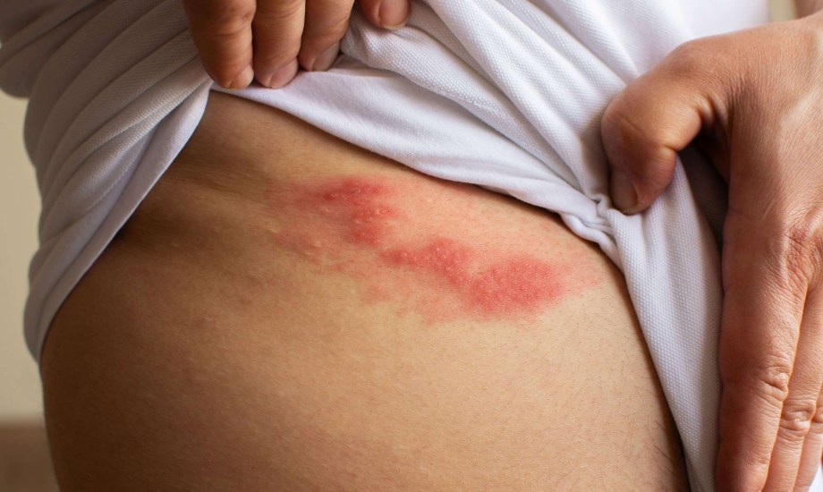 الحزام الناري.. أسبابه وأعراضه والفئات الأكثر عرضة للإصابة