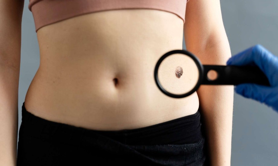 طرق الوقاية من ظهور الشامات