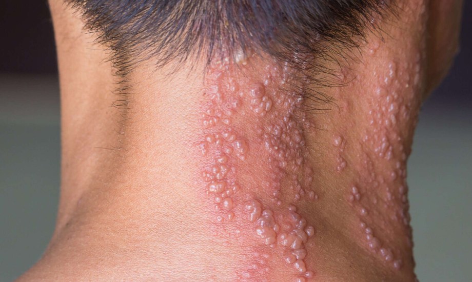 مضاعفات الإصابة بالحزام الناري