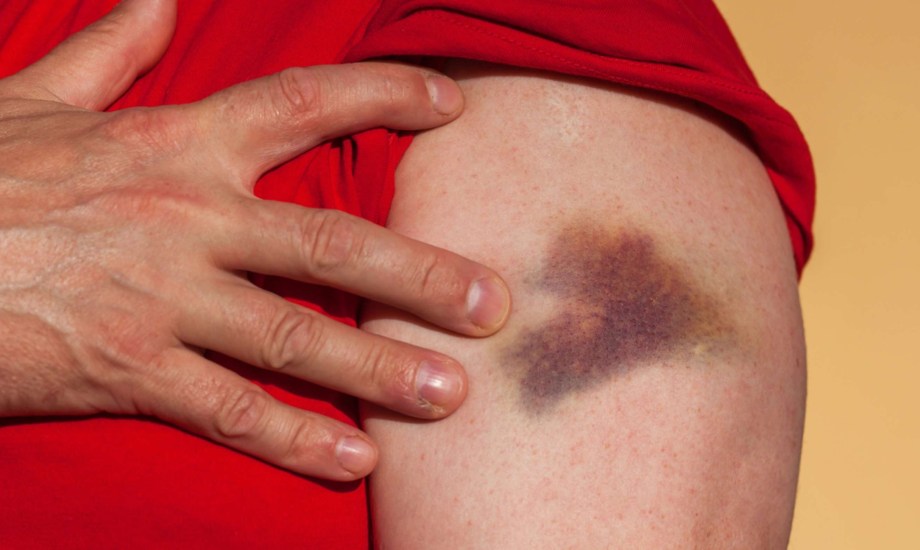 أدوية تسبب ظهور الكدمات