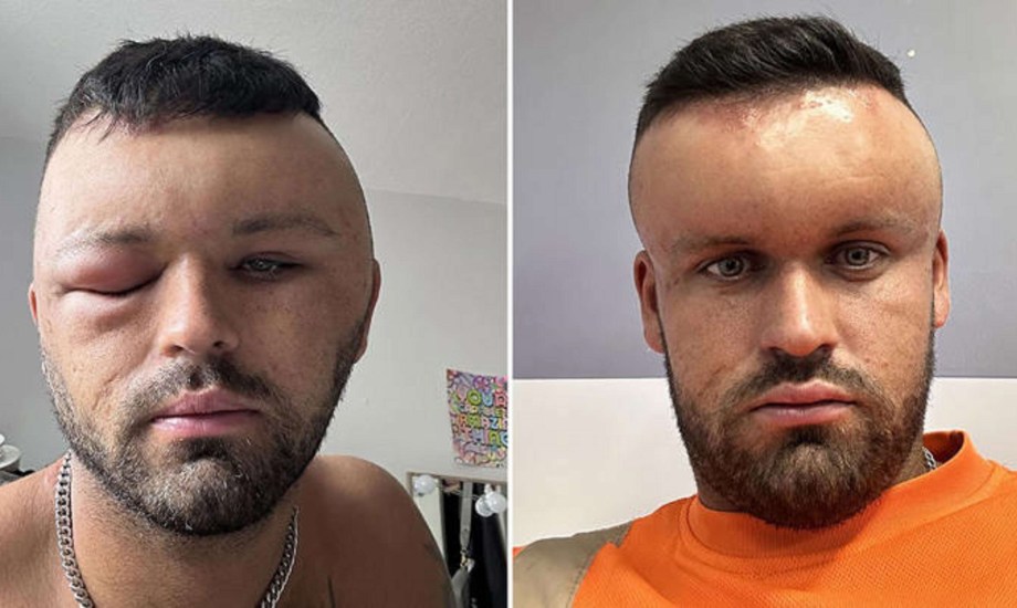 صبغة شعر تسبب انتفاخ رأس رجل بريطاني