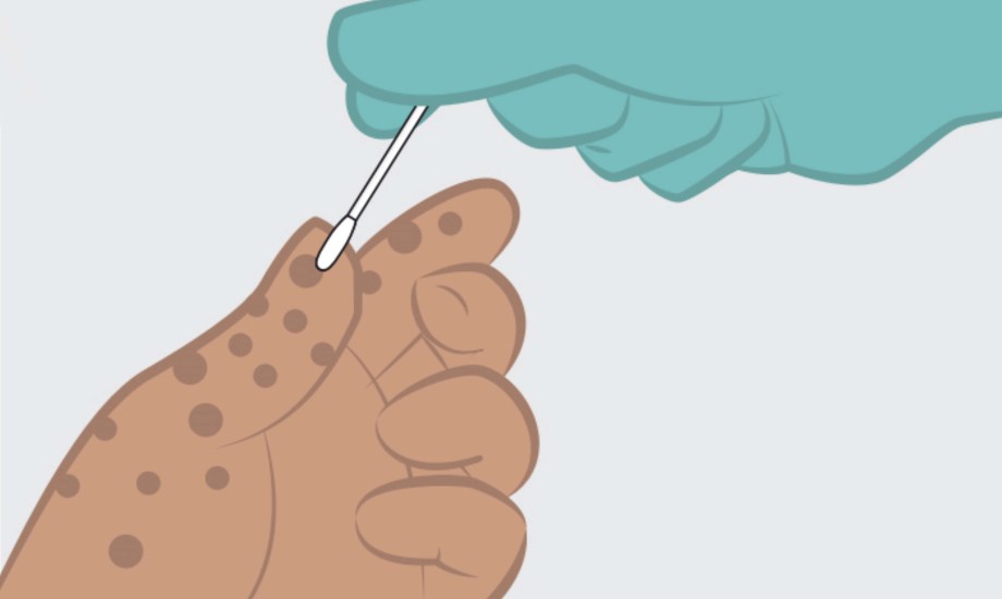 علاجات منزلية لتخفيف آلام جدري القردة