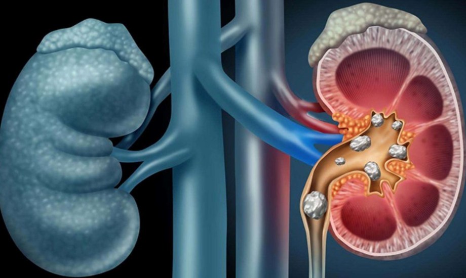 تقليل معدلات الكرياتينين في الجسم