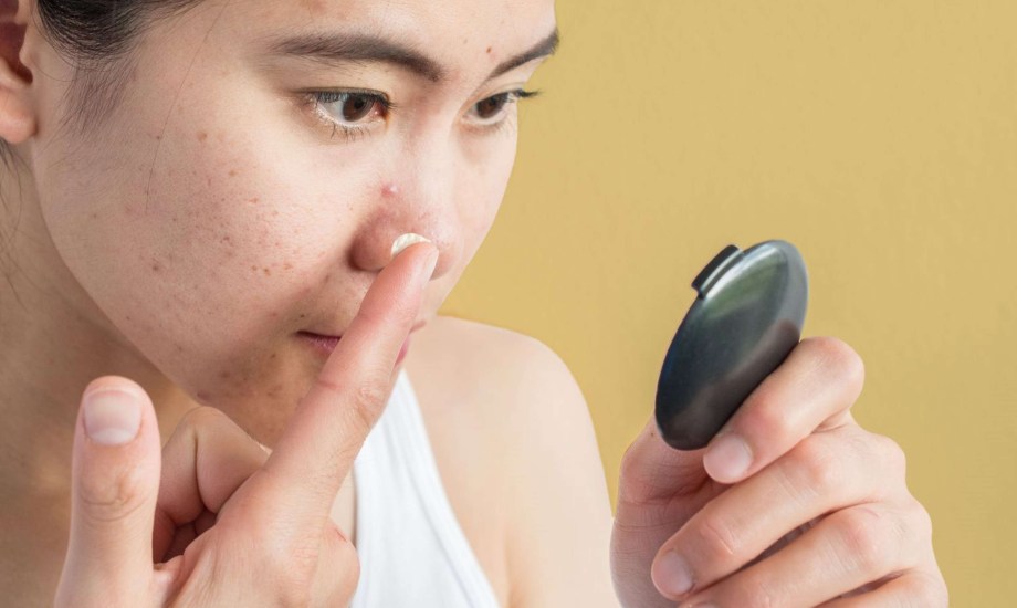 حمض الأزيليك لعلاج حب الشباب