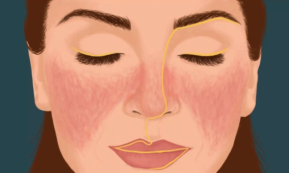 أنواع الذئبة الحمراء وأسبابه والفئات الأكثر عرضة 