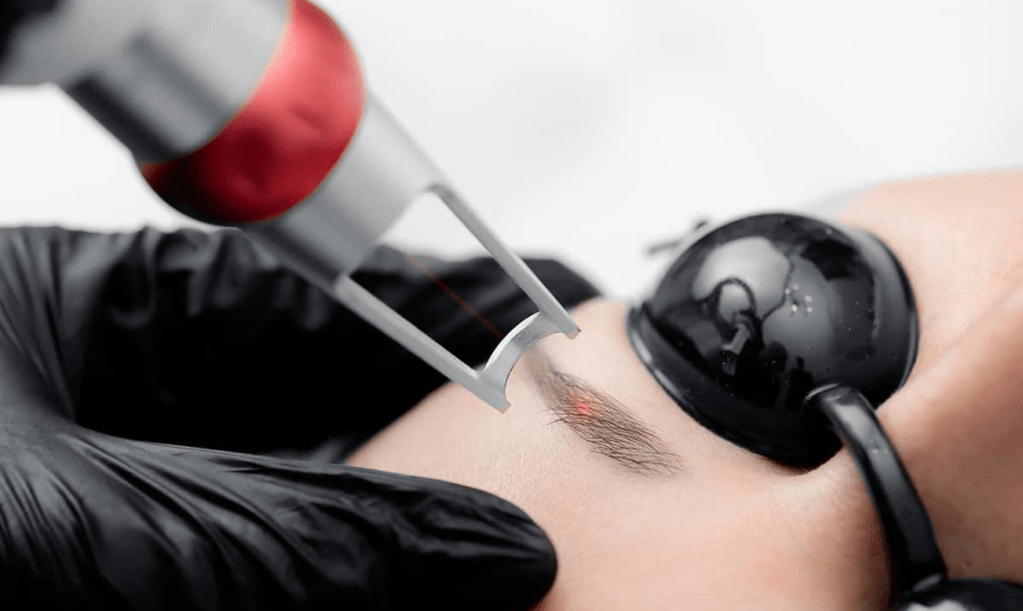 خطوات إزالة تاتو الحواجب