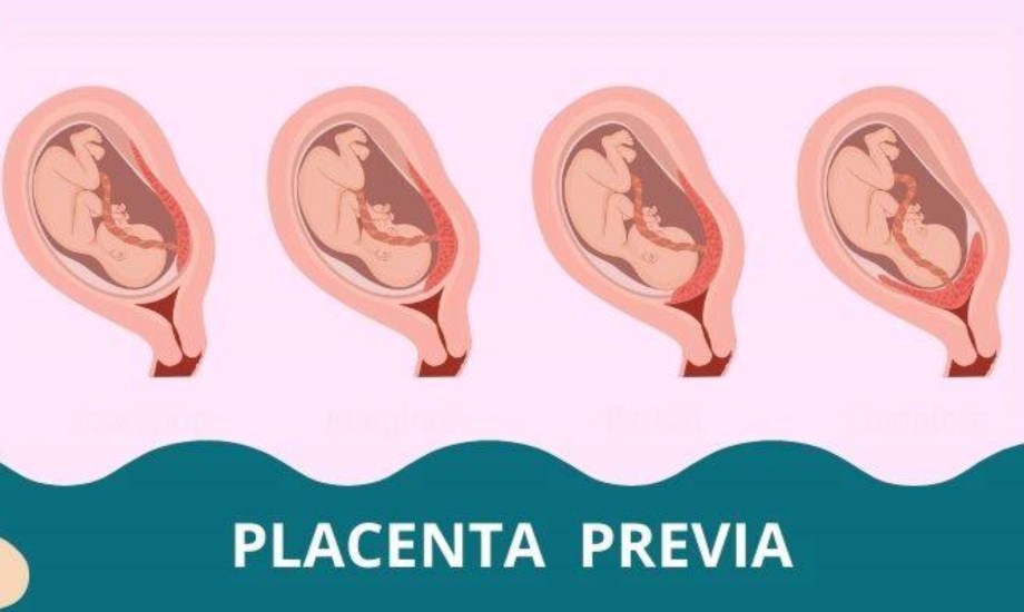 المشيمة المنزاحة.. أنواعها وأعراضها