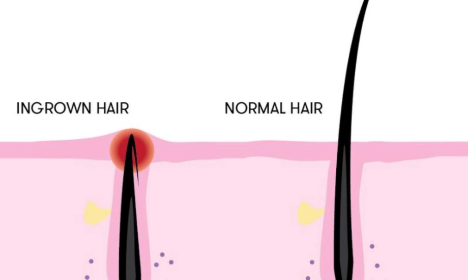 أسباب نمو الشعر تحت الجلد