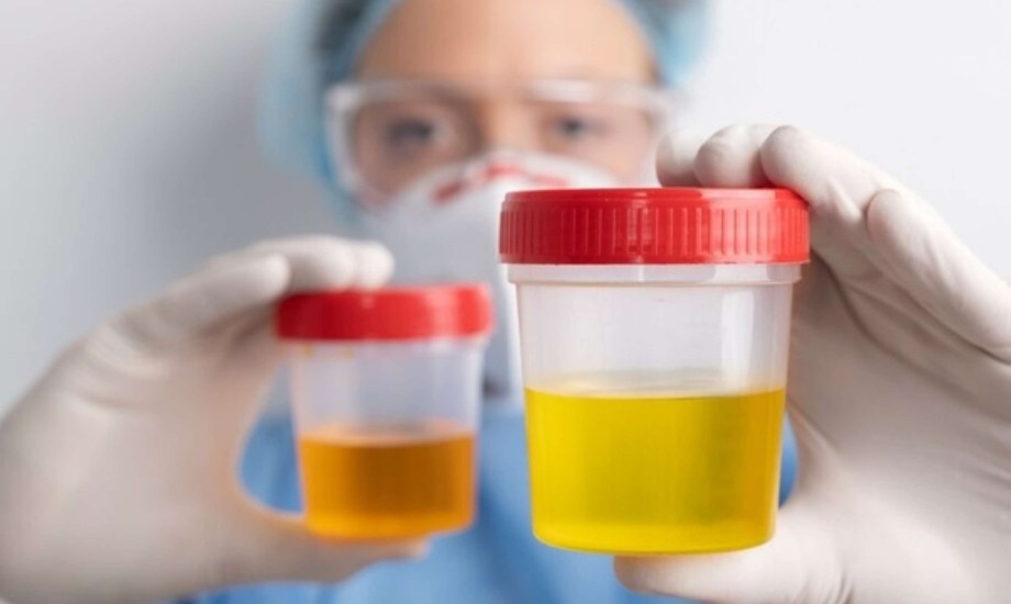 أدوية تغير لون البول إلى البرتقالي والبني والأحمر