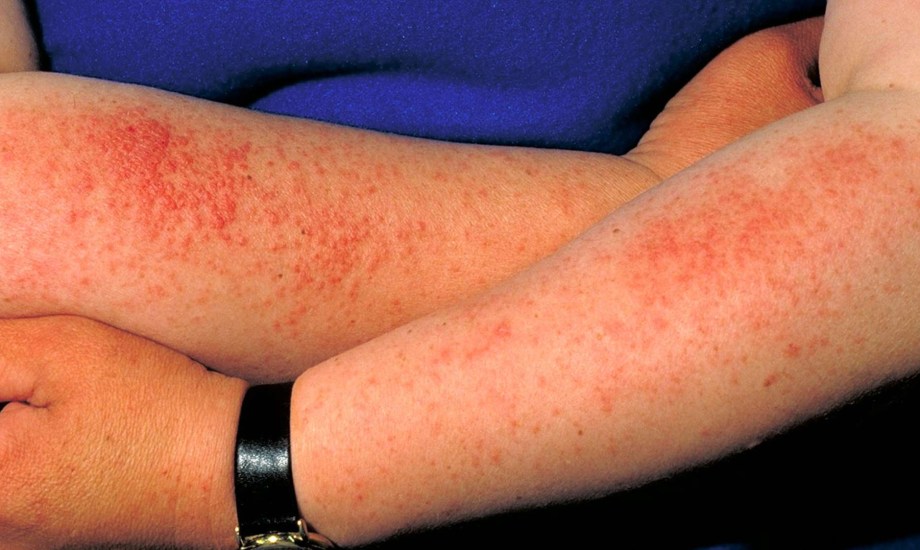 حساسية الشمس.. أنواعها وأسبابها وأعراضها