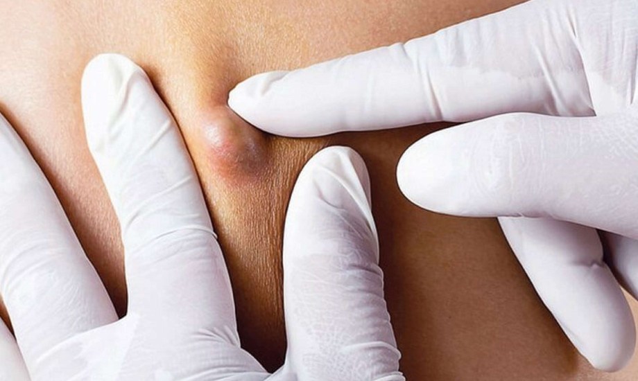 الفرق بين الكيس الدهني والخراج