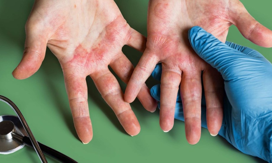 أنواع الإكزيما.. وطريقة علاجها