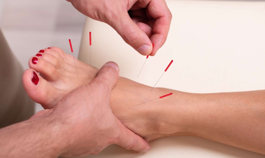 علاج متلازمة تململ الساقين بالوخز بالإبر