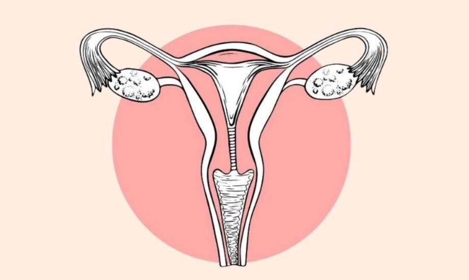 أسباب وأعراض متلازمة فرط تحفيز المبيض