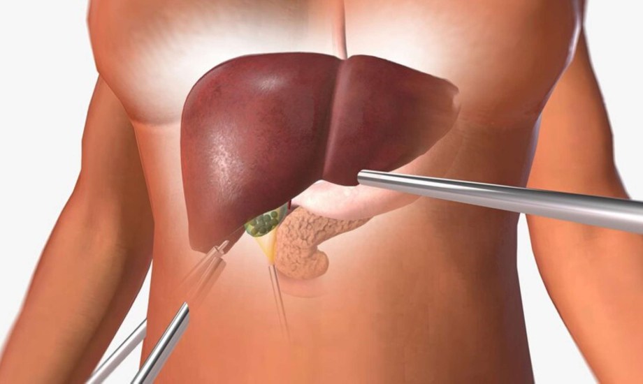 خراج الكبد.. الأسباب والمضاعفات وطرق العلاج