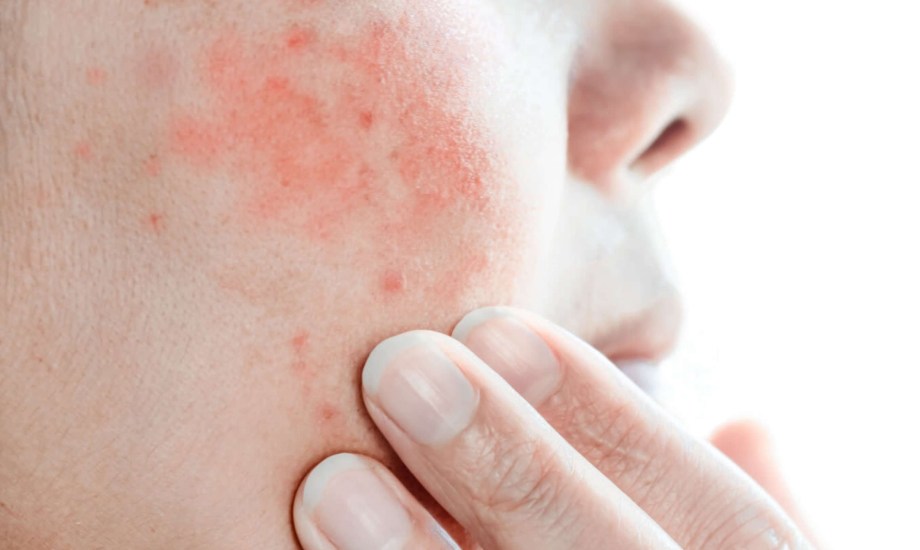 أسباب وأعراض متلازمة ستيفنز جونسون