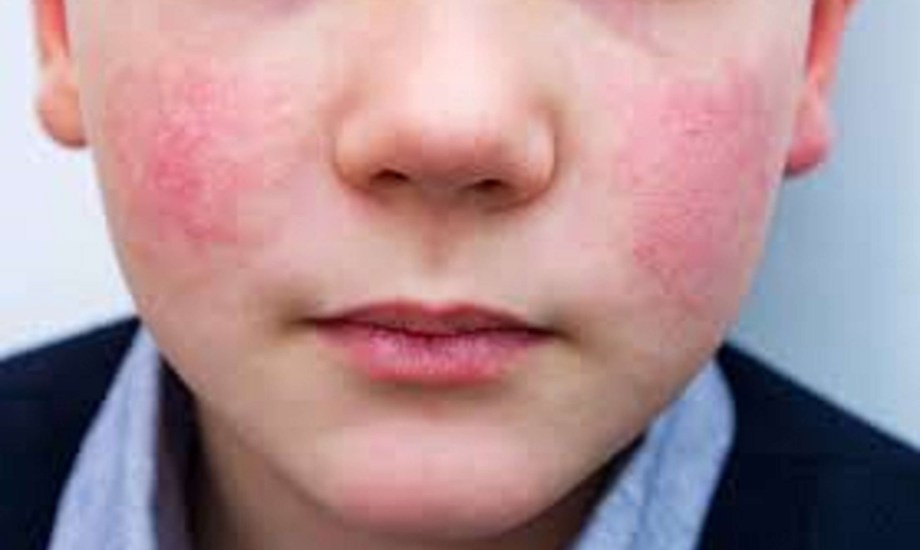 كل ما تريد معرفته عن فيروس الخد المصفوع