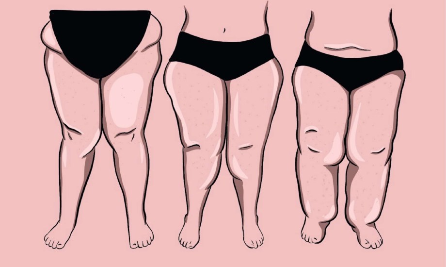 الوذمة الشحمية.. أسبابها وأنواعها