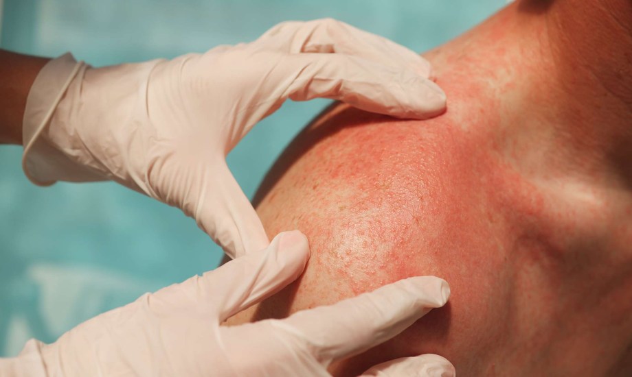 أعراض حساسية السلفا والفئات الأكثر عرضة 