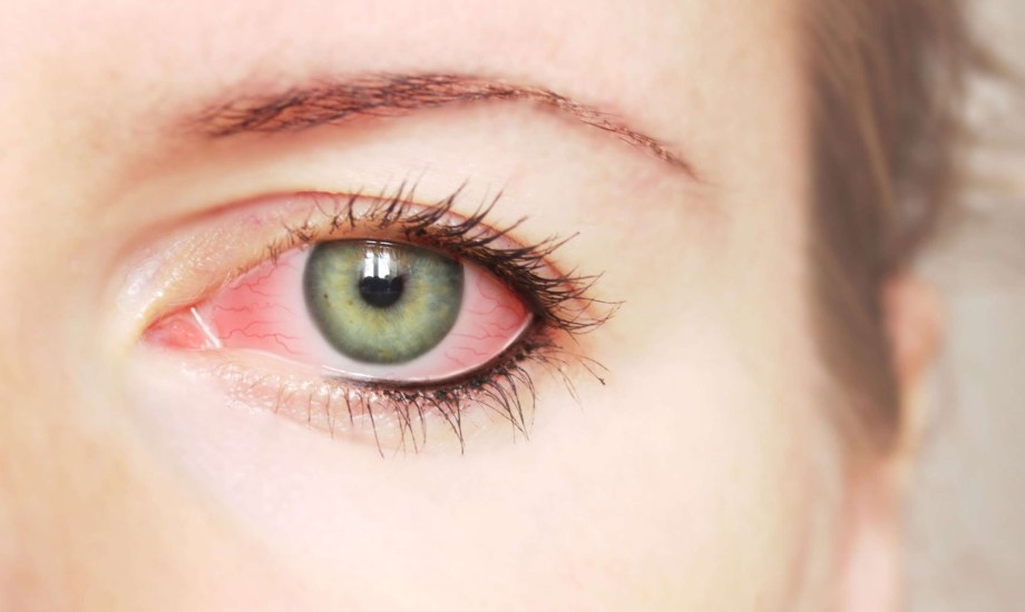 أسباب إصابة القرنية وأعراضها