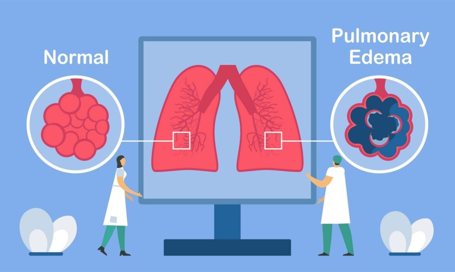 أسباب وأعراض الوذمة الرئوية