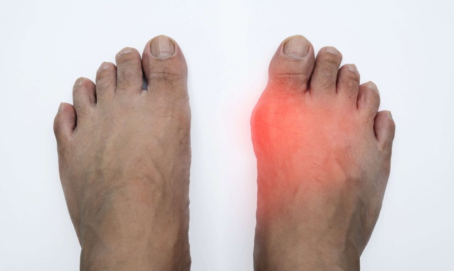 5 أسباب للإصابة بالغرغرينا.. السكري والجروح العميقة أبرزها