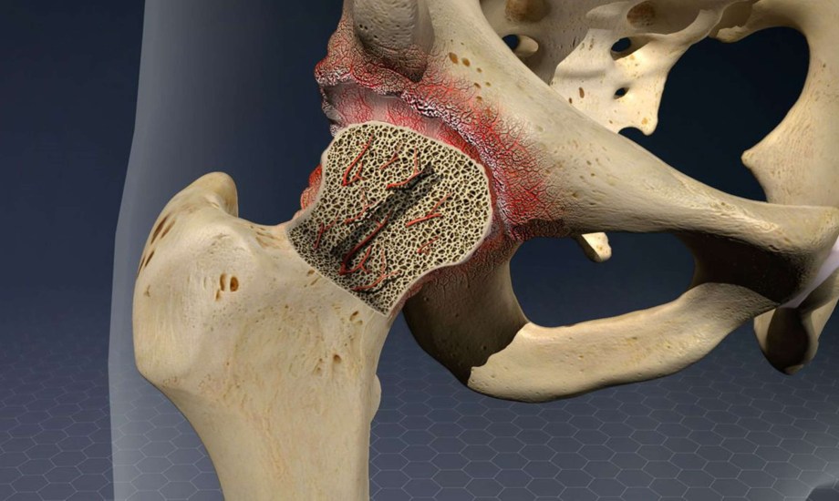  أسباب نخر العظم اللاوعائي
