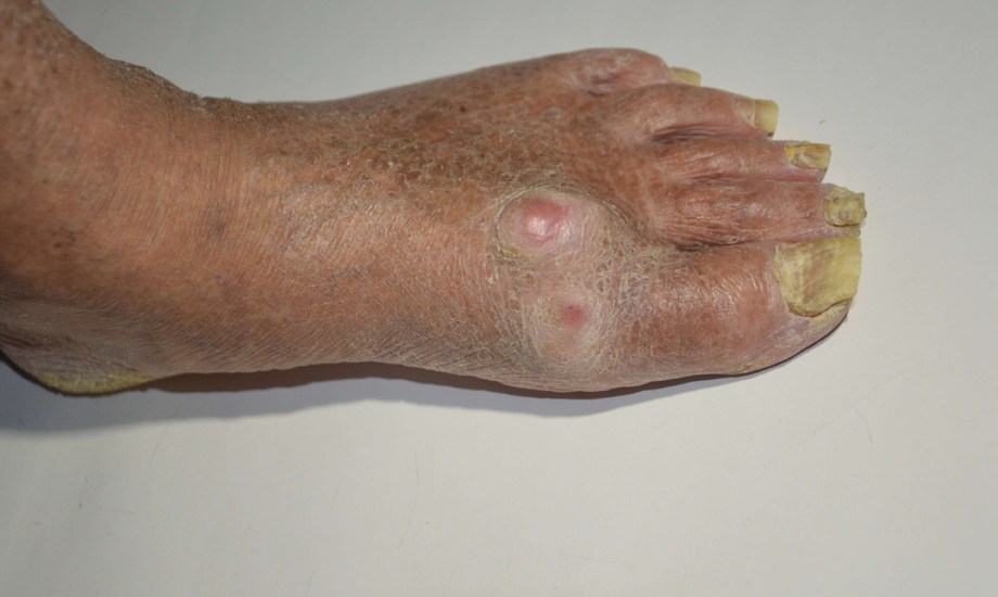 أعراض الإصابة بالغرغرينا