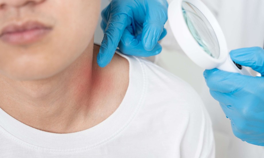 الفحص الذاتي لسرطان الجلد