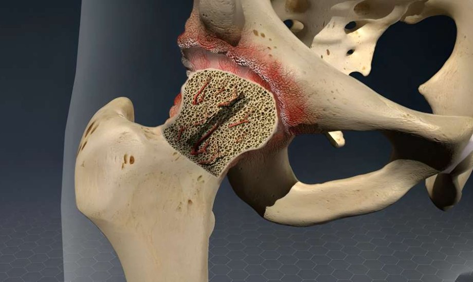 أعراض النخر اللاوعائي