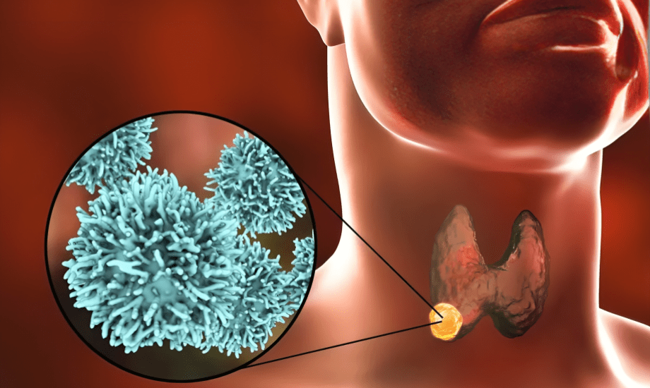 سرطان الغدد الليمفاوية لدى الأطفال