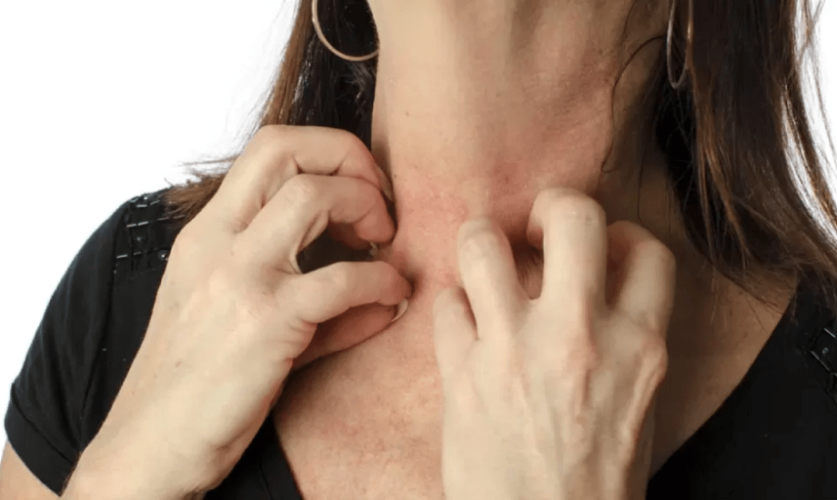 علاج تينيا الرقبة