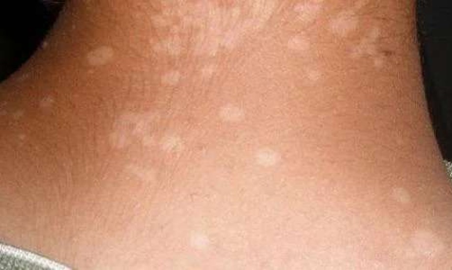 التينيا عدوى فطرية شائعة تصيب الجلد أو الأظافر