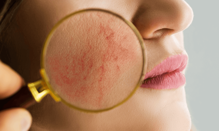 علاج تمزق الشعيرات الدموية في الوجه