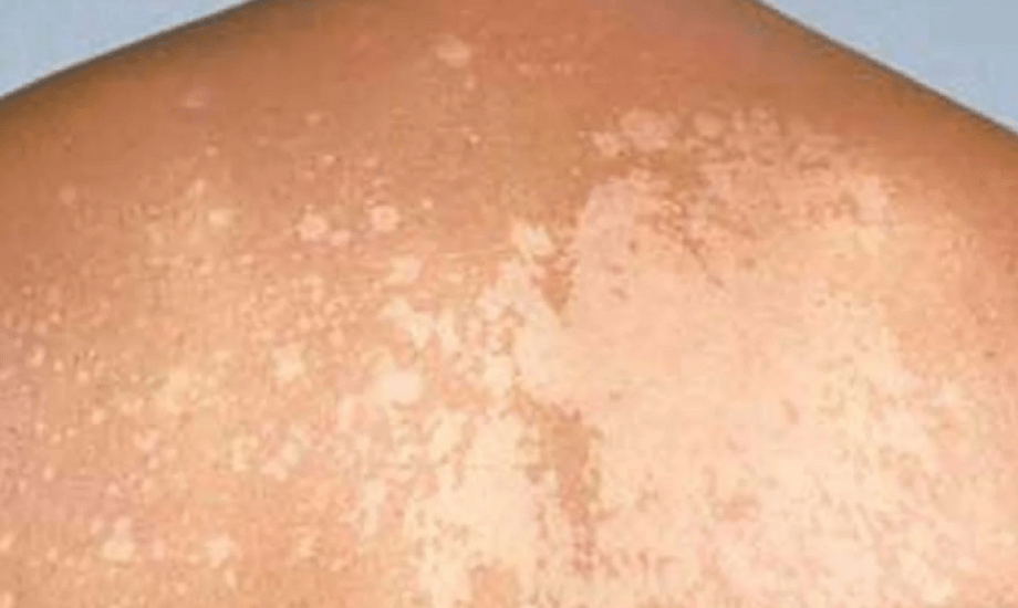 نصائح للوقاية من التينيا