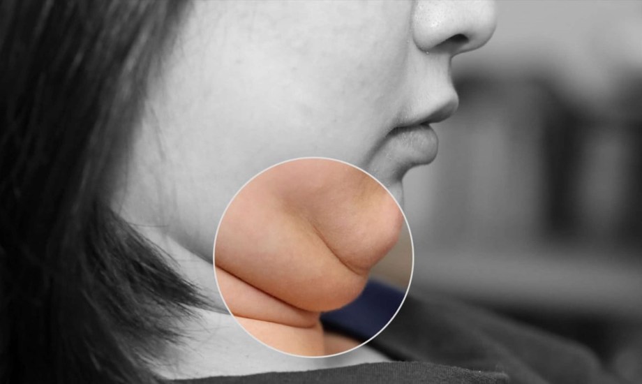 أسباب ظهور الذقن المزدوج