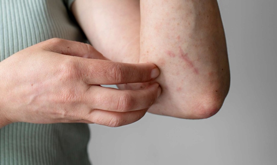 التينيا الملونة.. 3 علاجات فعالة و5 نصائح للوقاية من الإصابة