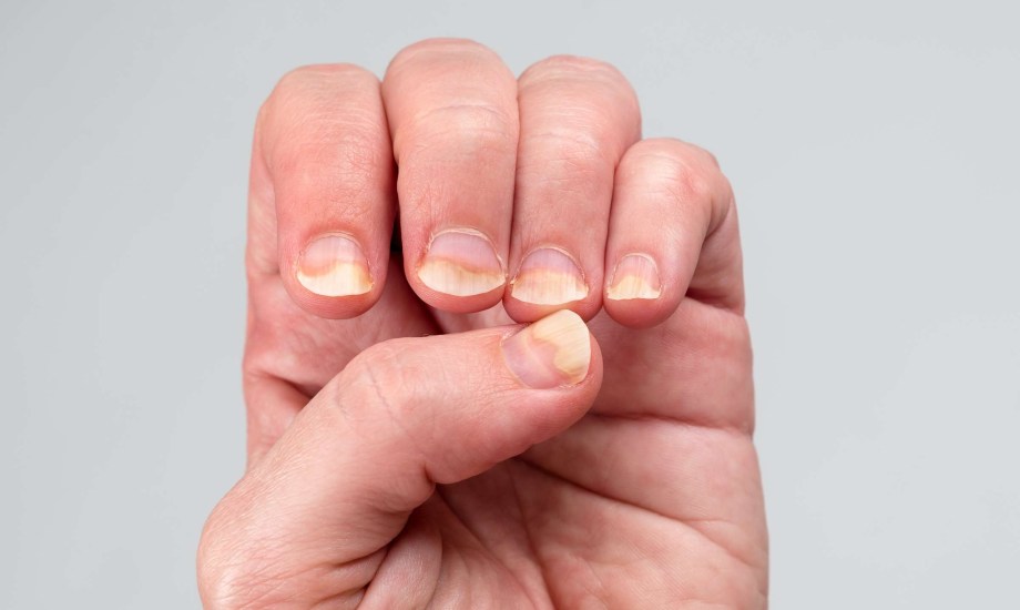 أسباب انحناء الأظافر