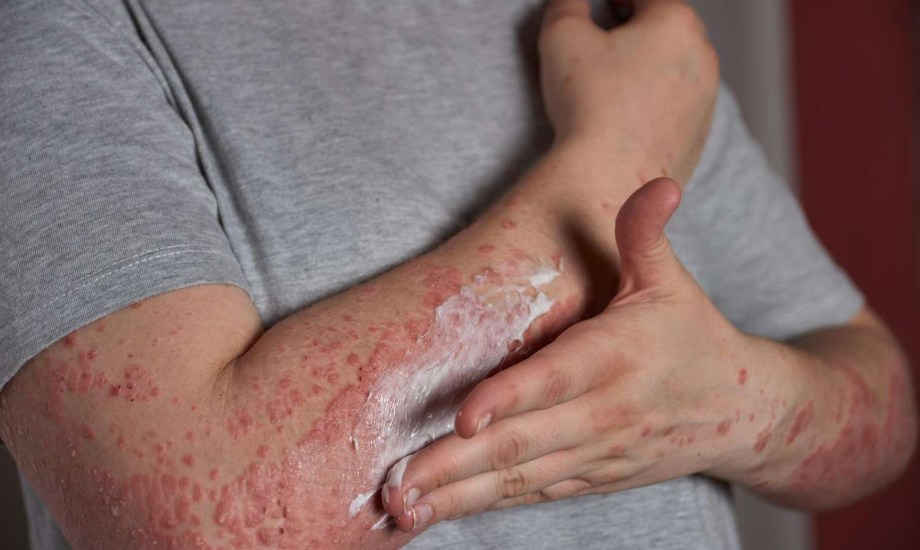 أعراض الذئبة الحمراء لدى الرجال