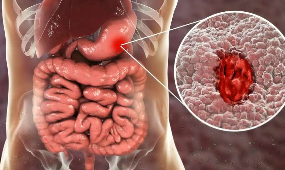 قرحة الأمعاء تزيد خطر الإصابة بالشلل الرعاش