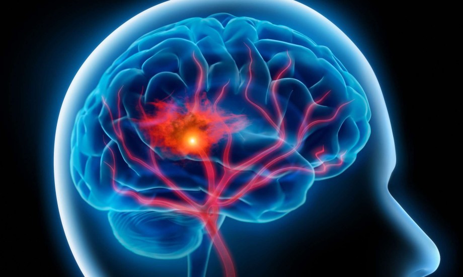 الرجال أقل عرضة للوفاة بسبب السكتة الدماغية