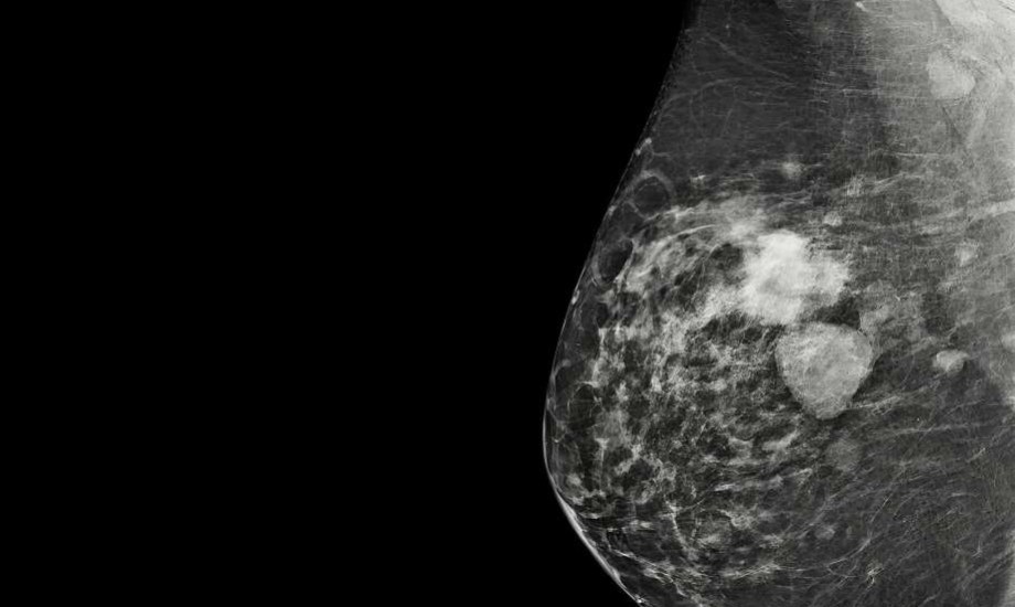 سرطان الثدي متعدد البؤر