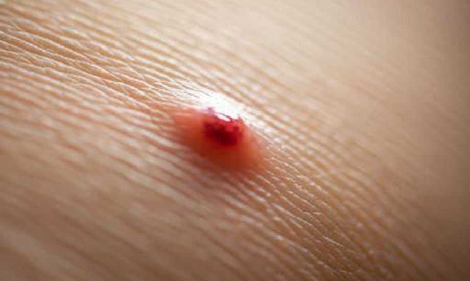 السنط من الأمراض الجلدية التي يمكن أن تصيب الأطفال والبالغين