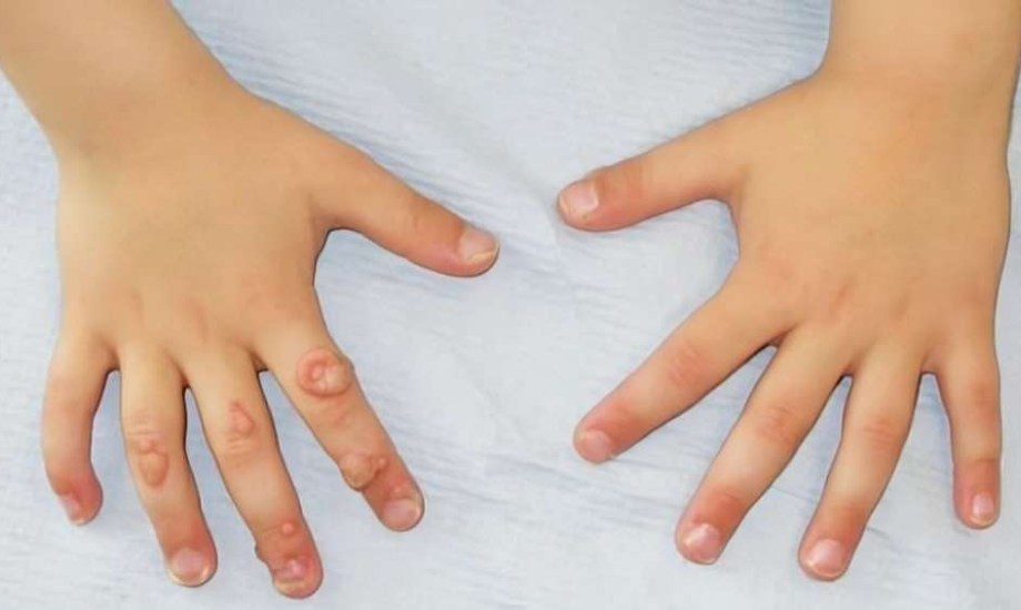 للوقاية من السنط 5 عادات عليك تطبيقها يوميا