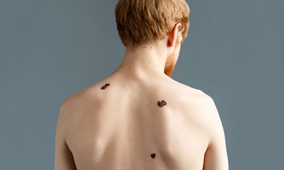 الرجال أكثر عرضة للوفاة بسرطان الجلد