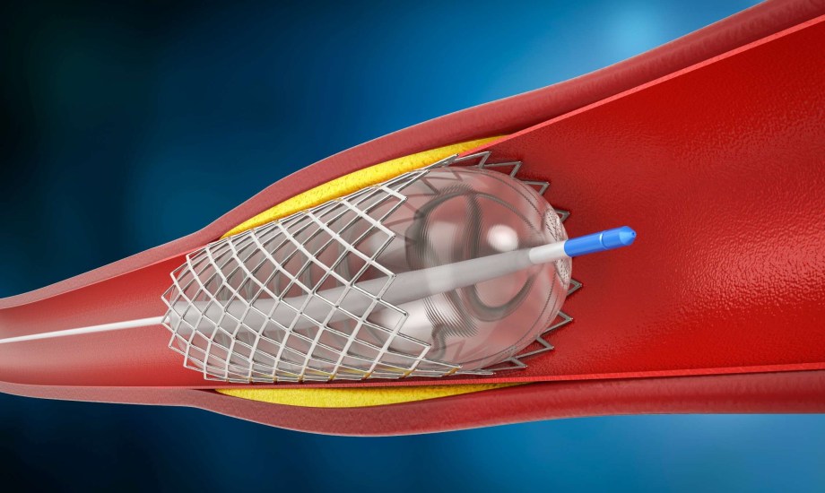 متى تكون الدعامة ضرورية؟