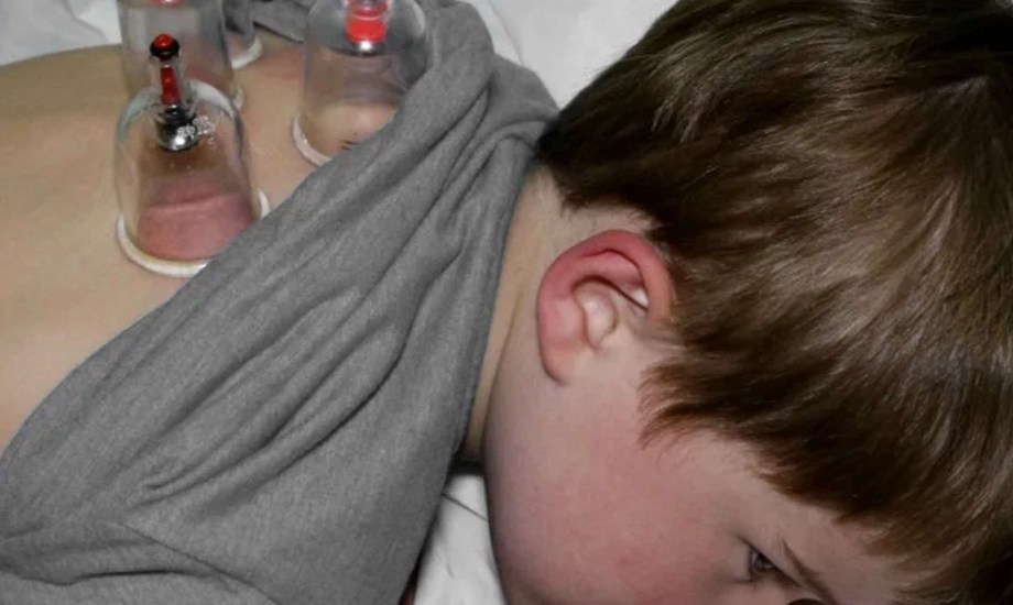 فوائد الحجامة للأطفال