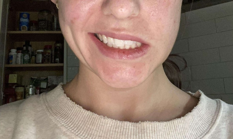 أسباب شلل الوجه النصفي