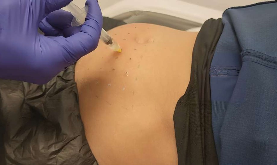 تقنية الميزوثيرابي للتخسيس